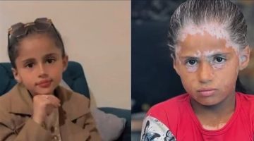 بسبب الفزع والخوف.. حكاية الطفلة الفلسطينية “لانا” التي غير قصف الاحتلال لون جلدها وشعرها
